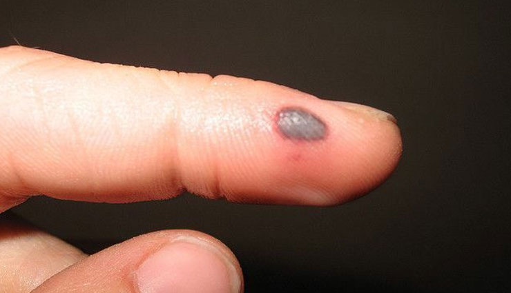 blood blisters,home remedies to treat blood blisters,Health tips,fitness tips