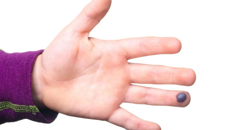 blood blisters,home remedies to treat blood blisters,Health tips,fitness tips