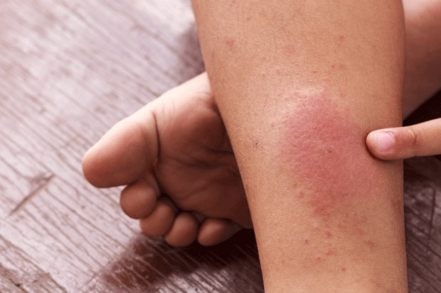 home remedies,home remedies to prevent blood clot,blood clot,Health tips,fitness tips