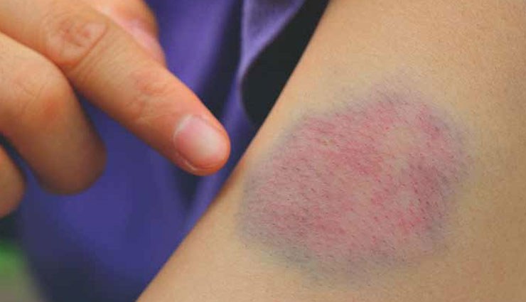 5 Natural Remedies That Prevent Blood Clot