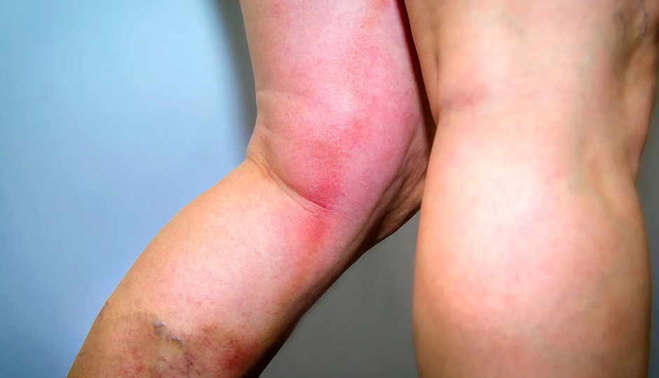 7 Herbs and Spices That Helps To Prevent Blood Clots