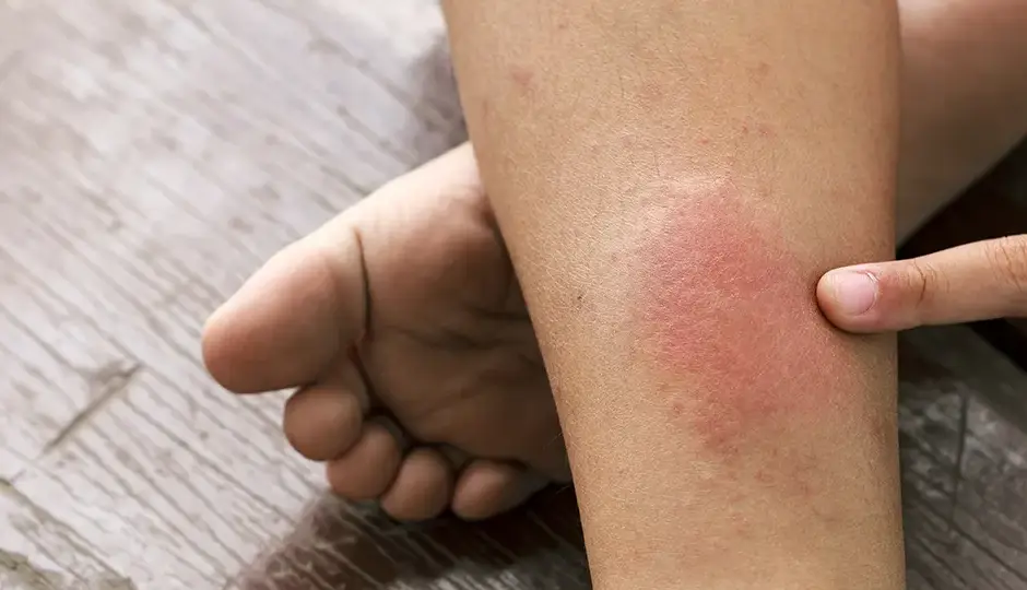 8 Major Signs and Symptoms of Blood Clot in Legs