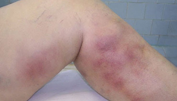 8 Signs and Symptoms of a Blood Clot To Watch Out For in Your Leg