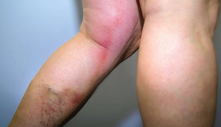 blood clot symptoms in leg,signs of blood clot in leg,blood clot warning signs,leg blood clot symptoms,dvt symptoms,deep vein thrombosis signs,blood clot leg pain,blood clot in leg skin changes