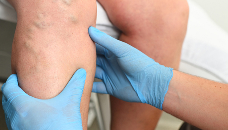 blood clots,arterial blood clots,venous blood clots,deep vein thrombosis (dvt),heart attack,stroke,blood clot symptoms,preventing blood clots,health risks of blood clots,blood clot treatment,american heart association