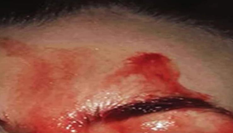 weird disease,blood is coming out of sweat,italy