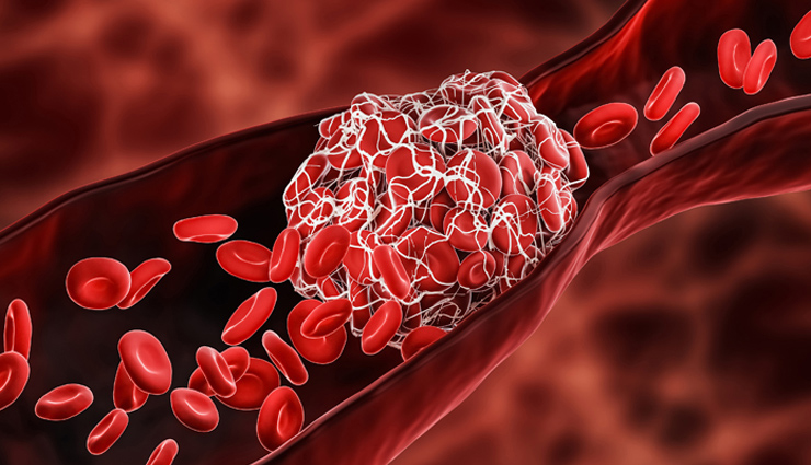 जानलेवा साबित हो सकता हैं खून का गाढ़ापन, पतला करने के लिए आजमाएं ये उपाय 