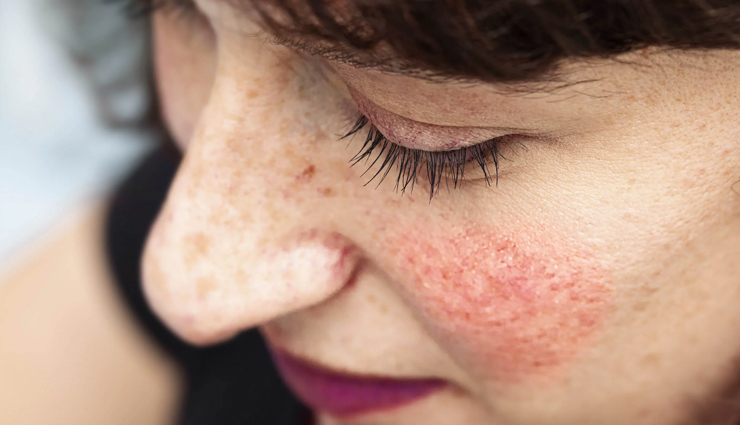5 Home Remedies To Treat Blotchy Skin