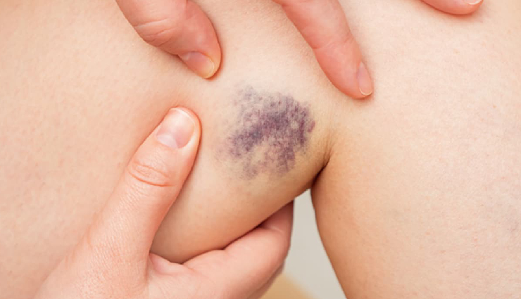 liver damage signs,skin abnormalities liver damage,blue rashes liver disease,skin itching liver damage,spider angioma liver dysfunction,halitosis liver impairment,palmar erythema liver damage,facial hyperpigmentation liver dysfunction,liver health warning signs,symptoms of liver damage