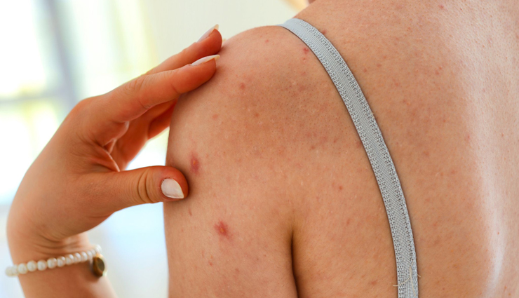 ways to use tea tree oil,tea tree oil for acne,beauty tips,beauty hacks