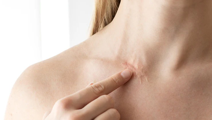 effective home remedies for body scars,scar treatment at home,natural scar healing,reduce body scars,home remedies for scars,scar removal remedies,how to fade scars naturally,scar treatment tips,natural ways to treat scars,healing scars with home remedies