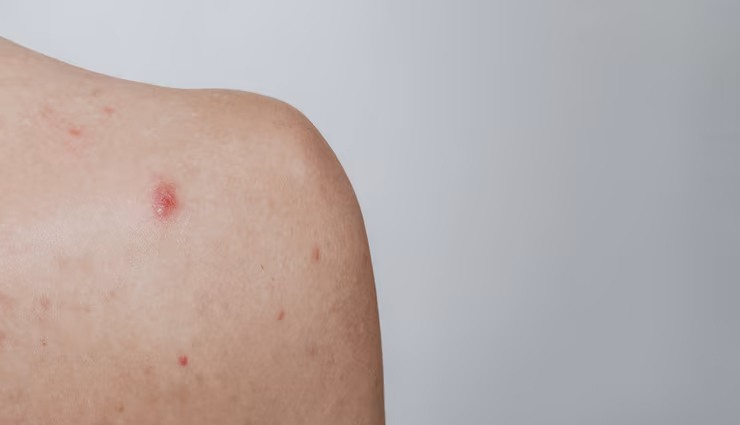 home remedies for boils,treat boils naturally,how to cure boils,boil treatment,natural remedies for boils,boils on skin,home treatment for furuncles,prevent boils,boil healing tips,boil infection remedies