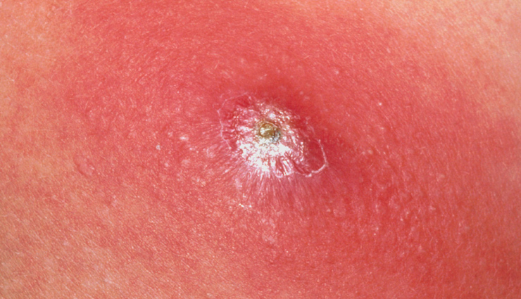 6 Effective Home Remedies To Cure Boils