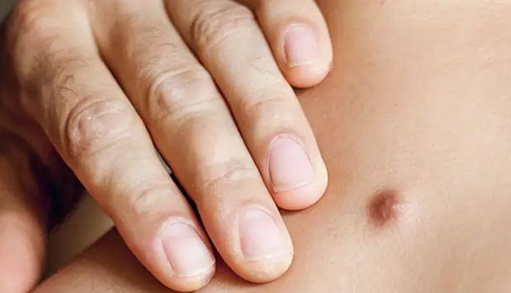 home remedies for boils,treat boils naturally,how to cure boils,boil treatment,natural remedies for boils,boils on skin,home treatment for furuncles,prevent boils,boil healing tips,boil infection remedies