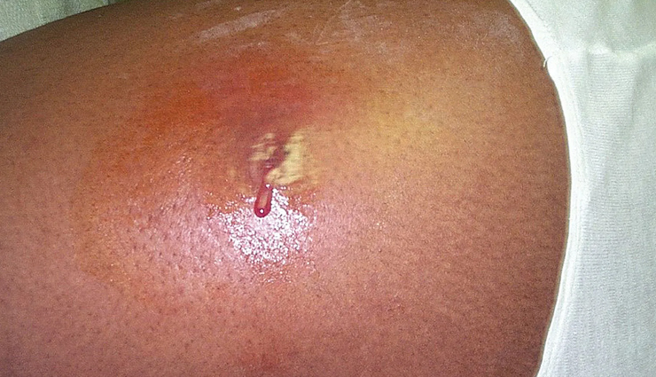 8 Best Home Remedies To Treat Boils and Carbuncles