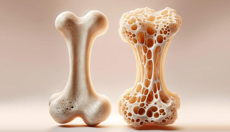 10 Must Try Home Remedies To Increase Bone Density