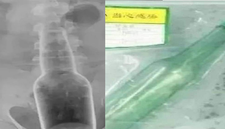 गुप्तांग में 7 इंच लंबी बोतल देख डॉक्टर के उड़े होश, ऑपरेशन कर निकाली