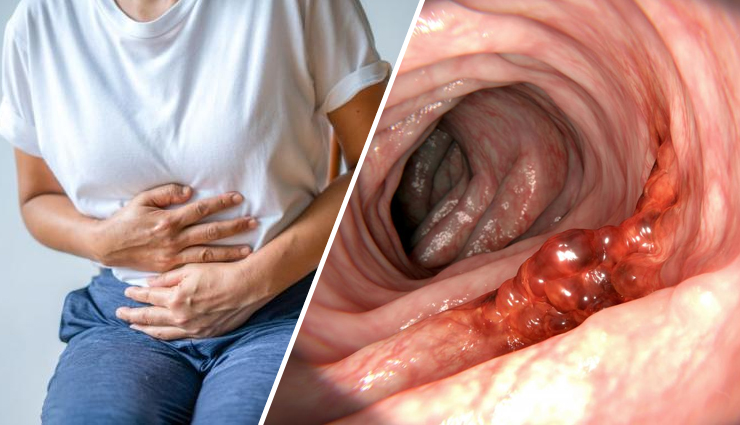 7 Early Signs of Bowel Cancer You Should Not Ignore