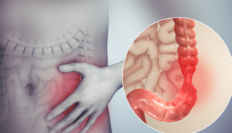 5 Foods to Avoid with Irritable Bowel Syndrome