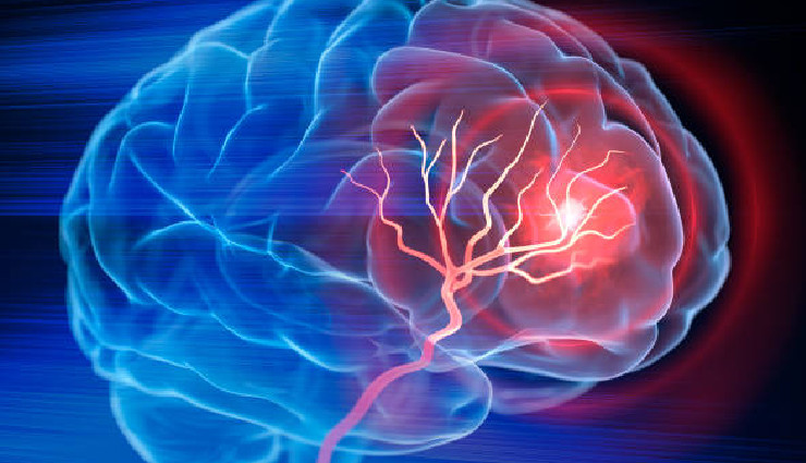 health conditions affecting personality,personality changes medical conditions,alzheimers disease,dementia with lewy bodies,huntingtons disease,parkinsons disease,thyroid disorders,multiple sclerosis,brain tumor,cancer impact on personality,stroke personality changes,traumatic brain injury,bipolar disorder,depression,schizophrenia,obsessive-compulsive disorder