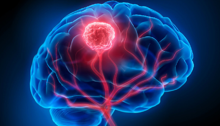 7 Major Signs of Brain Tumour To Be Aware About