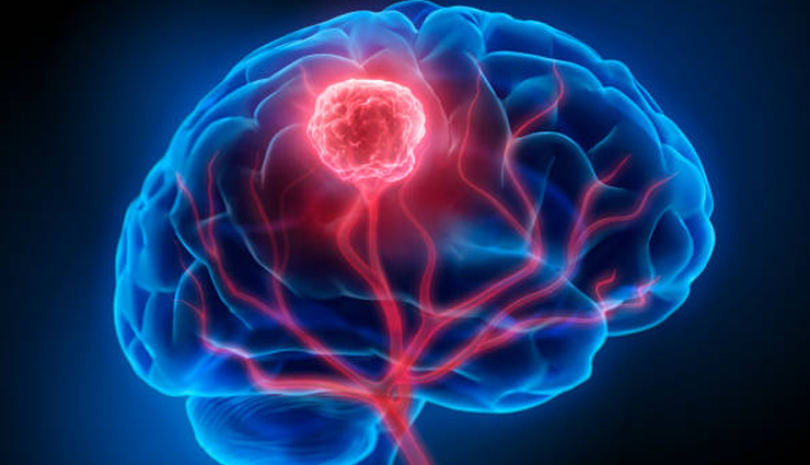 world brain tumor day 2022,brain tumour,health news,Health tips