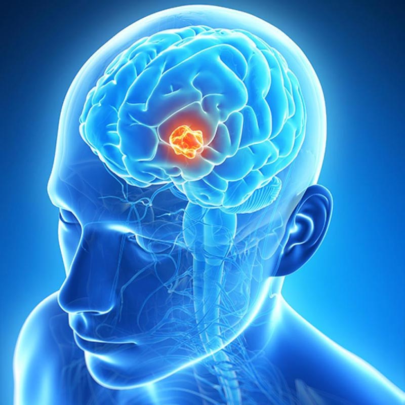 irrfan khan,brain tumor,brain tumor types,brain tumor symptoms,Health,Health tips ,इरफ़ान खान,ब्रेन ट्यूमर,हेल्थ,हेल्थ टिप्स