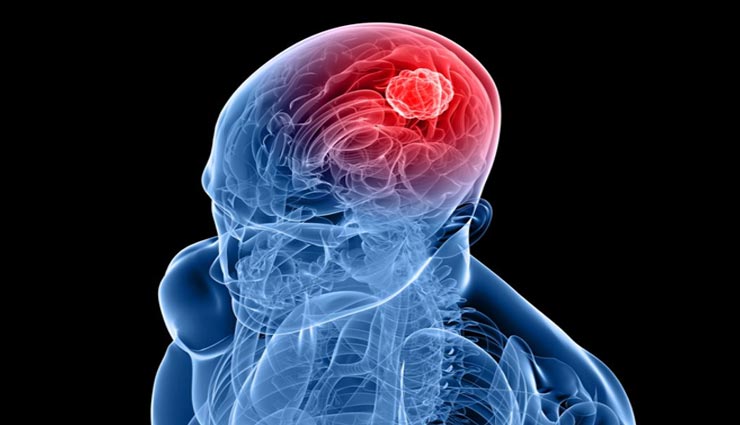 शरीर के ये 7 बदलाव दर्शाते हैं ब्रेन में ट्यूमर, जानें और सतर्क रहें