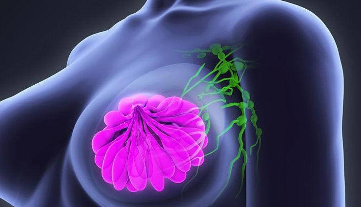 महिलाओं के लिए खतरा बनता जा रहा है स्तन कैंसर, जानें इससे बचाव के घरेलू उपाय 