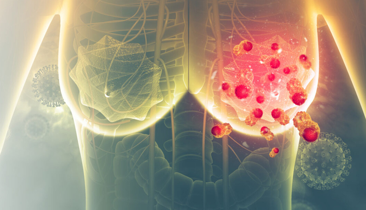 benign breast conditions,non-cancerous breast lumps,types of benign breast diseases,breast lumps that are not cancer,benign breast tumors,fibroadenoma causes and treatment,cysts in breast symptoms,breast pain non-cancerous causes,benign breast disease symptoms,how to identify benign breast lumps,treatment for benign breast conditions,difference between benign and malignant breast lumps,non-cancerous breast growths,common benign breast disorders,when to see a doctor for breast lumps