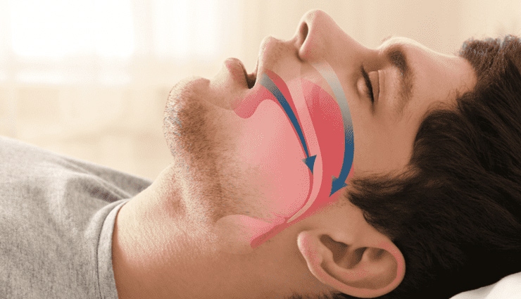 bappi lahiri,bappi lahiri death,bappi lahiri death reason,obstructive sleep apnea,obstructive sleep apnea causes,obstructive sleep apnea treatment,health news,health updates