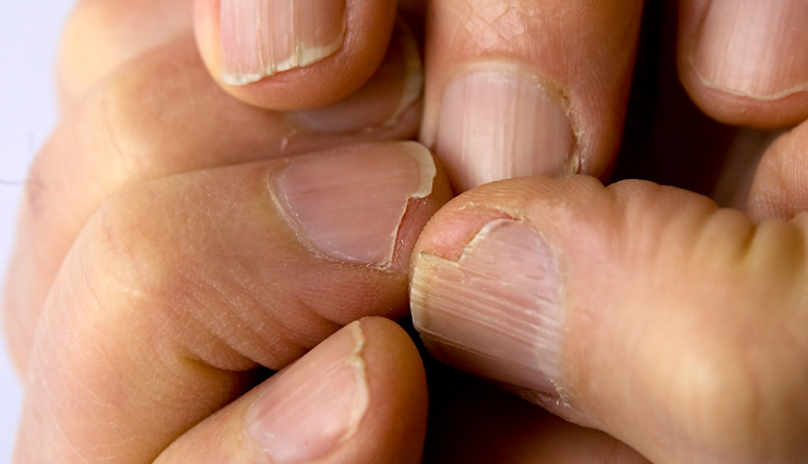 Effective Home Remedies To Treat Brittle Nails And Make Them Look Beautiful