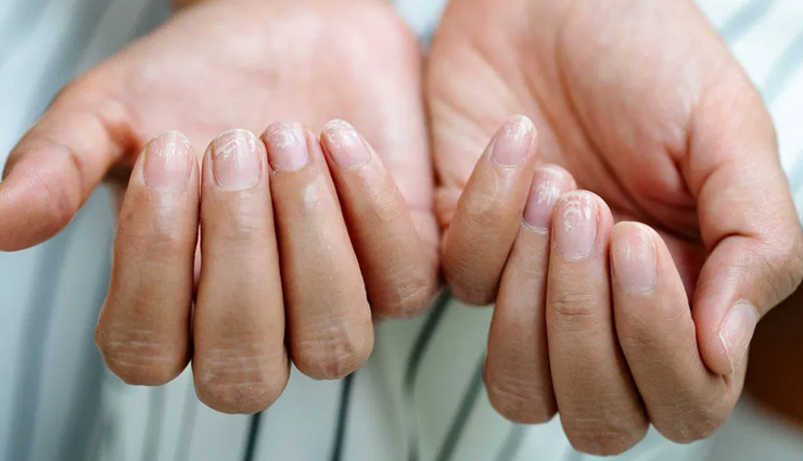 6 Home Remedies To Help Improve The Problem of Brittle Nails