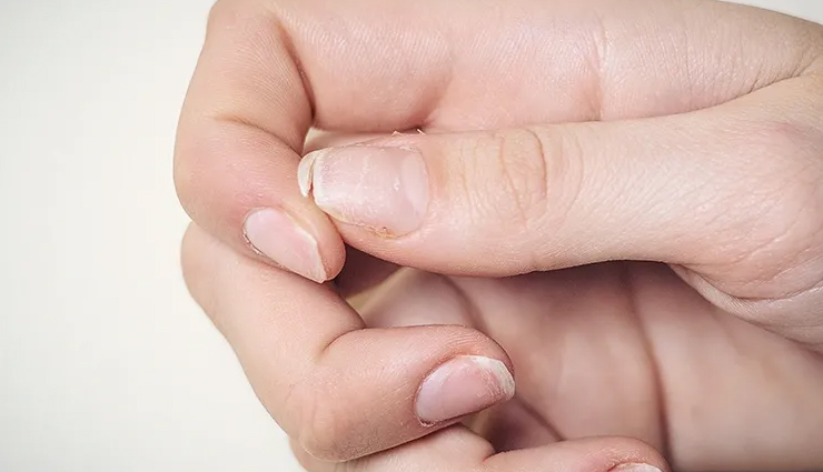 10 Home Remedies To Treat Brittle Nails