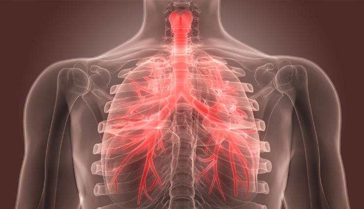 13 Remedies To Treat Bronchitis Symptoms at Home