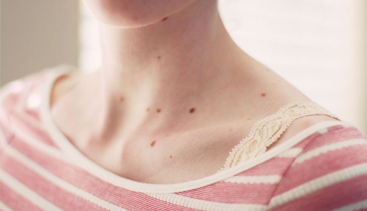 Get Rid of Brown Spots on Skin With These Home Remedies
