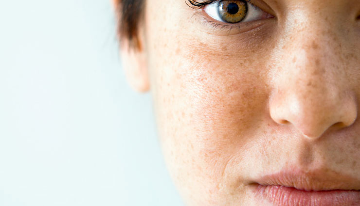 5 Home Remedies To Get Rid of Brown Spots From Skin