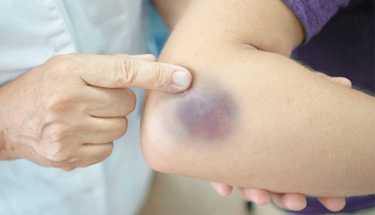 bruises,home remedies,home remedies for bruises,Health tips,fitness tips