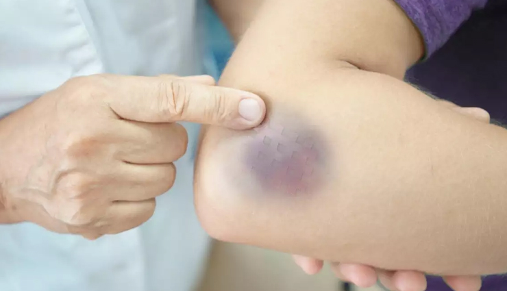 Heal Your Bruises Easily WIth These Remedies