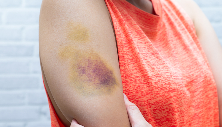 bruises,remedies to treat bruises,home remedies,remedies,Health,Health tips