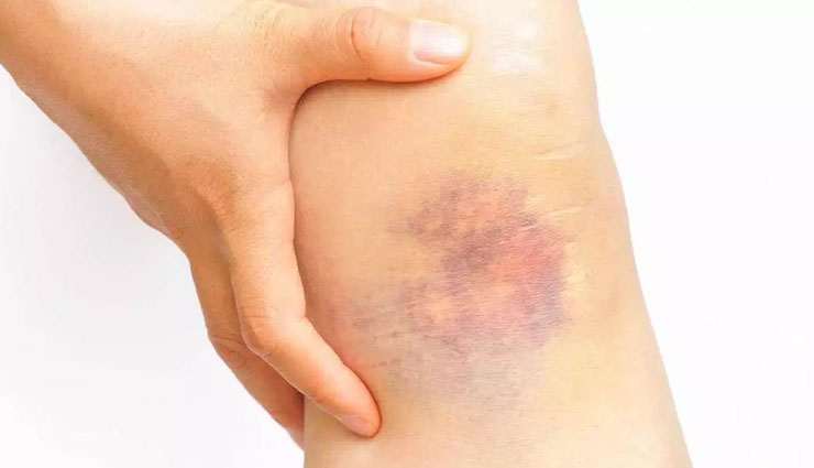 bruises,home remedies,home remedies for bruises,Health tips,fitness tips