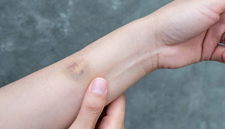 witch hazel skin benefits,skincare with witch hazel,reduce puffiness,combat acne with witch hazel,heal bruises naturally,minimize open pores,treat varicose veins,soothe sunburn,affordable skincare solutions,witch hazel oil benefits