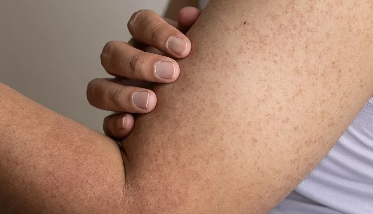 6 DIY Ways To Treat Bumpy Skin at Home