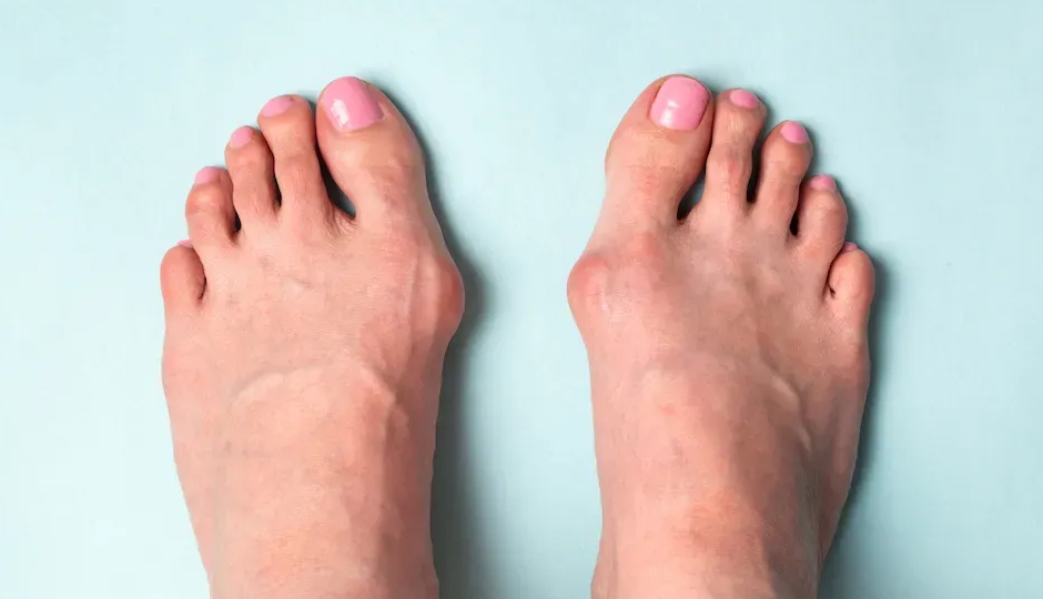 6 Effective Remedies for Bunion Pain