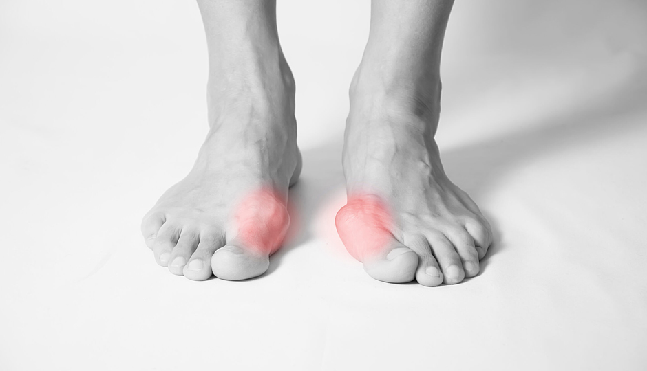 bunion causes,bunion treatment,bunion pain relief,foot deformities,non-surgical bunion remedies,bunion prevention,flat feet and bunions,hammertoe,foot care tips,bunion management,arthritis and bunions,inherited foot type,bunion exercises,bunion discomfort