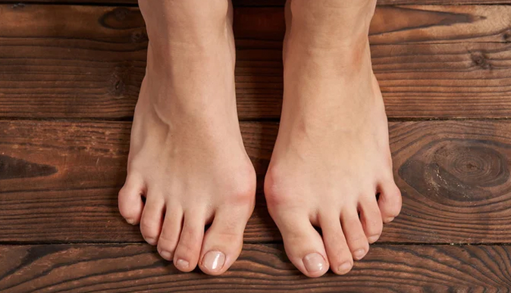 10 Remedies to Dissolve Bunions Naturally at Home