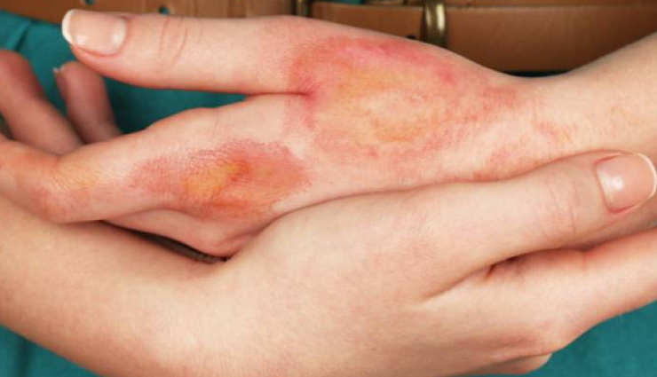 home remedies for common ailments,natural remedies for cough,sore throat home remedies,headache relief remedies,upset stomach remedy,home remedy for burns,natural insect bite treatment,ayurveda home remedies,ginger for cold,aloe vera for burns,turmeric for cuts,digestion home remedies,ayurvedic treatments,indian traditional healing,herbal remedies for health