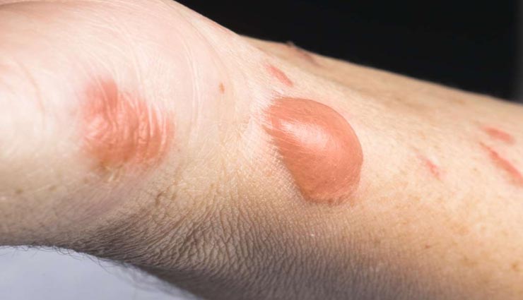 पटाखों की जलन में ध्यान रखें ये बातें, लापरवाही पड़ सकती हैं भारी 