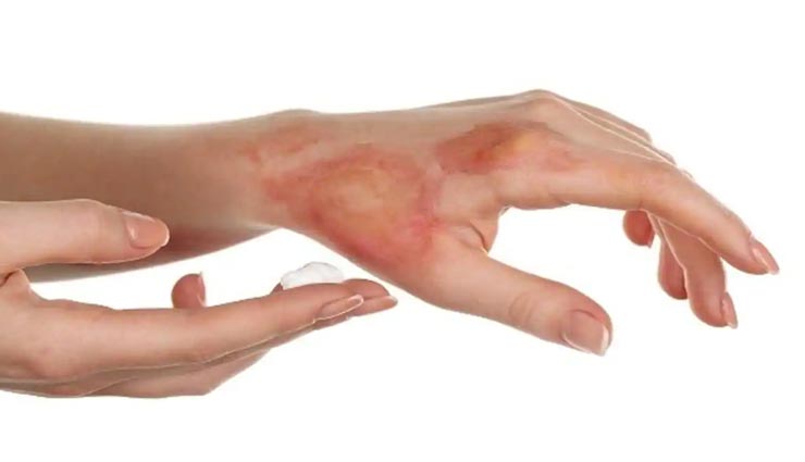 Health tips,health tips in hindi,home remedies,burn skin remedies,relief in burn skin irritation
