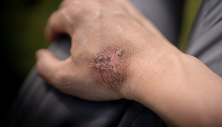 5 Remedies To Lighten Burn Scars Naturally